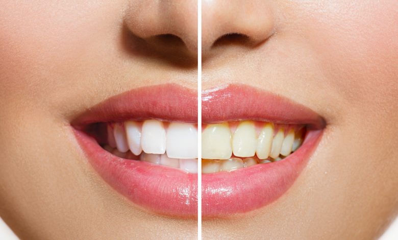 اصفرار الأسنان: الأسباب ووصفة سحرية لعلاجه